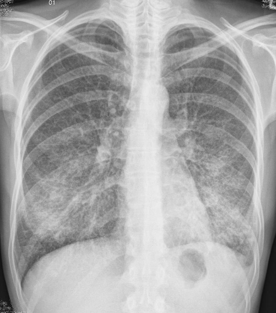 Padrões para o tratamento de pneumonia em crianças