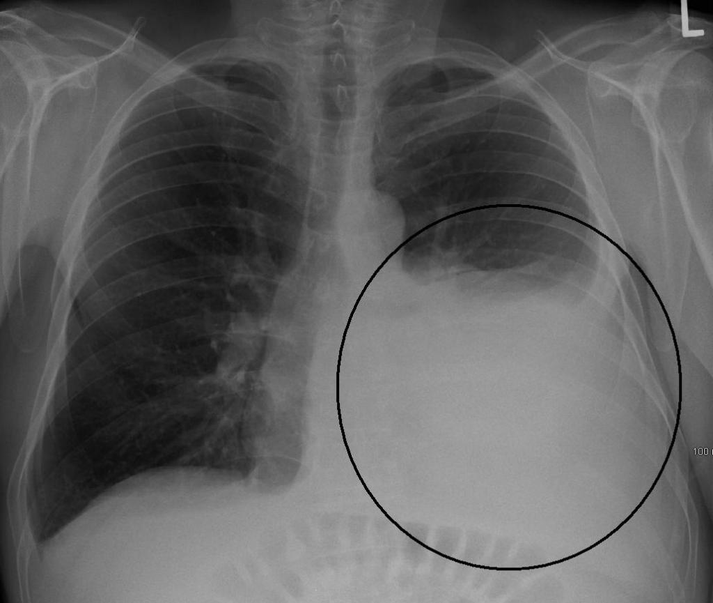 Padrão de tratamento de pneumonia ambulatorial